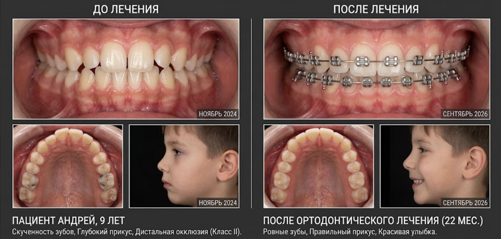 Пациент Андрей, 9 лет: исправление скученности зубов, глубокого прикуса и дистальной окклюзии на брекетах за 22 месяца